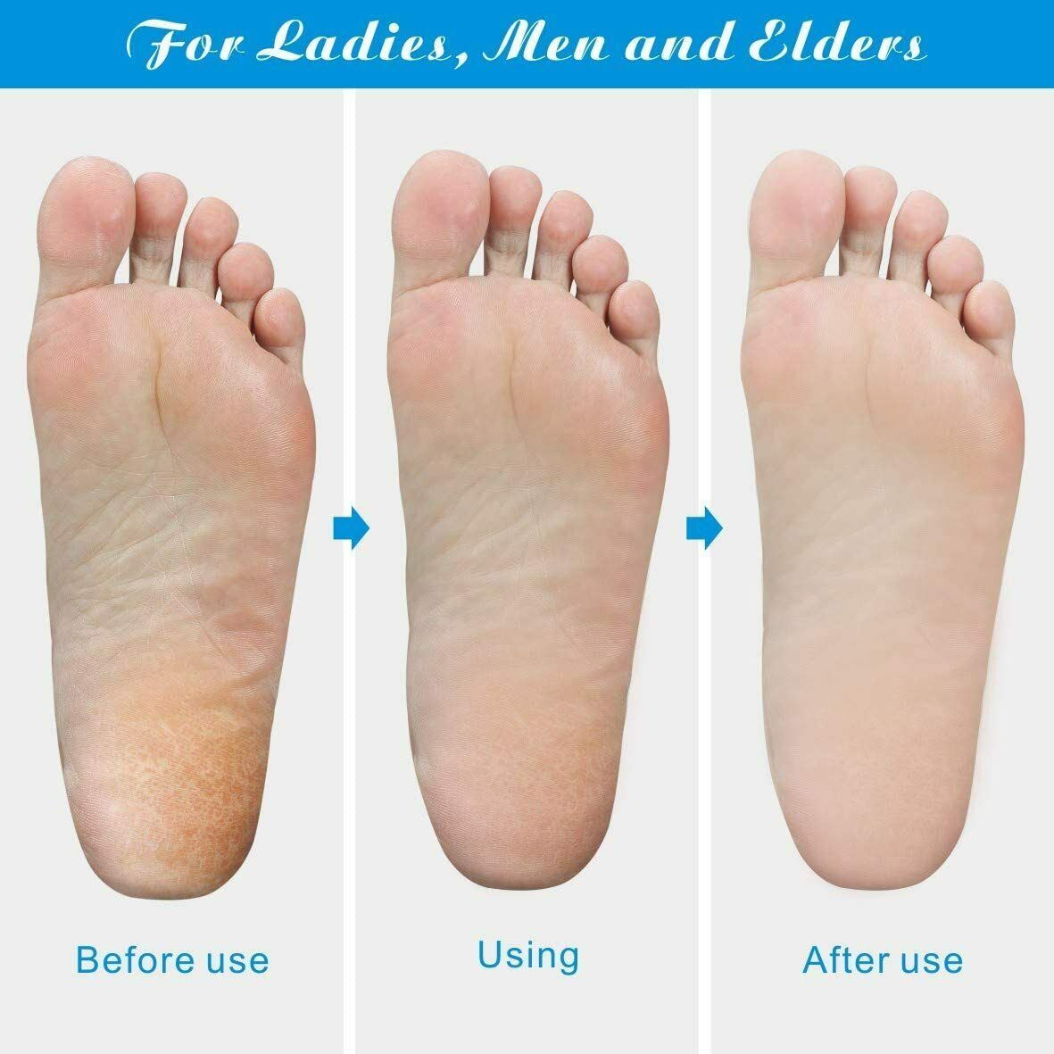 Callus Remover Pedicure Tool for Smooth, Soft Feet 6 Twokee.com
